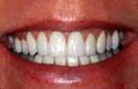 After San Diego California Teeth Whitening